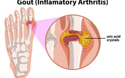 ARTHRITIS URICA (JICHT)