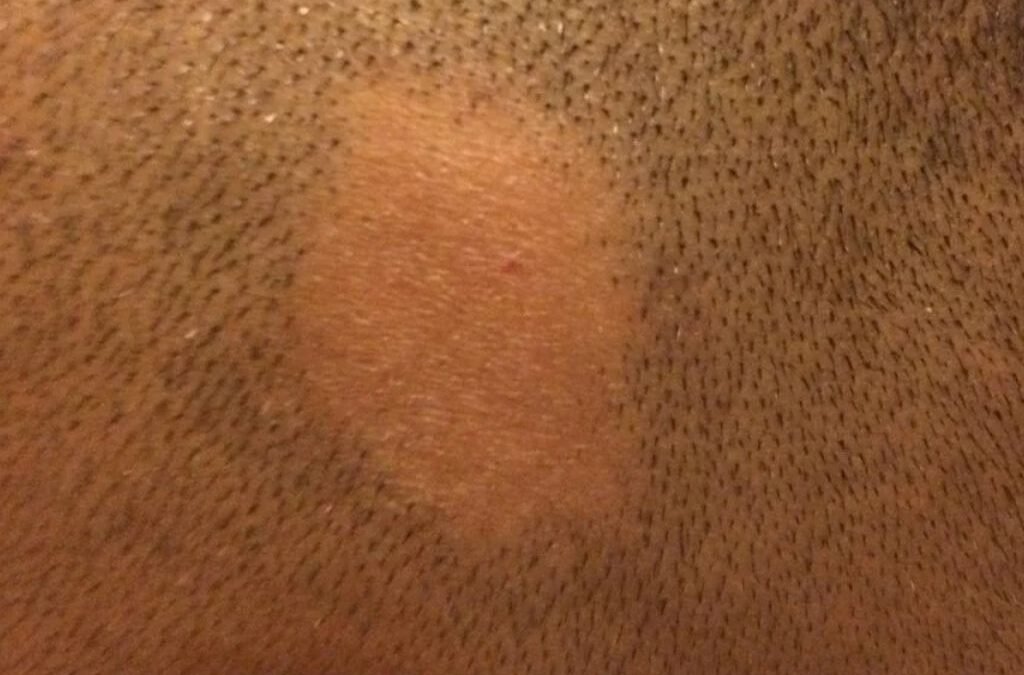 Alopecia areata