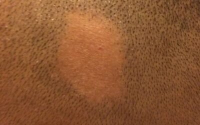 Alopecia areata