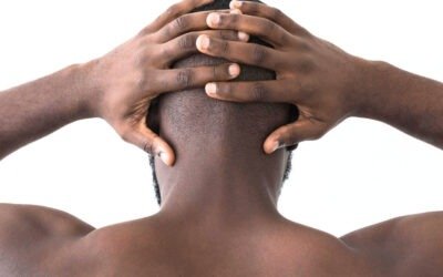 Alopecia areata