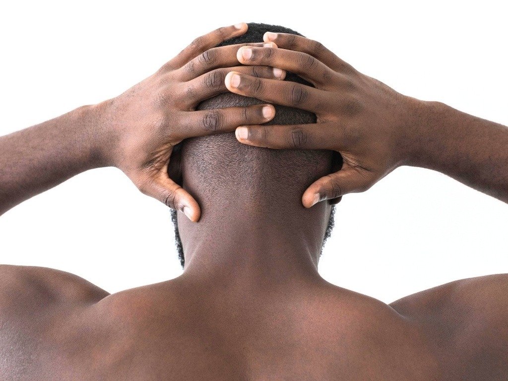 Alopecia areata betekent kaalheid die pleksgewijs ontstaat
